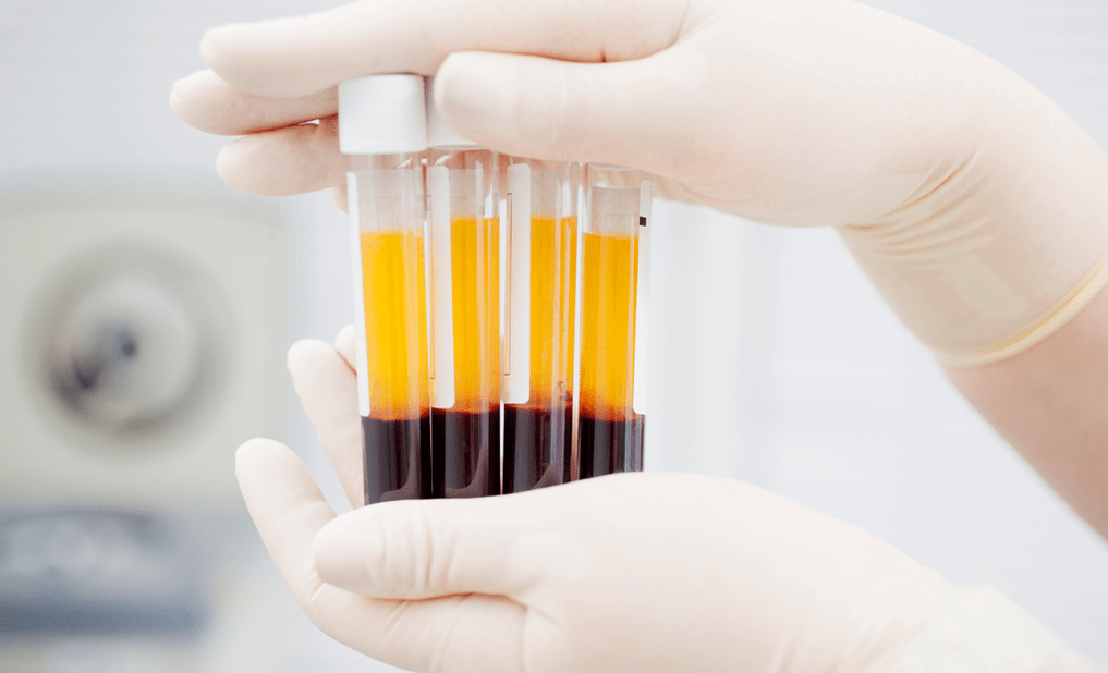 Ar trombocītiem bagātināta plazma artrozes PRP terapijai